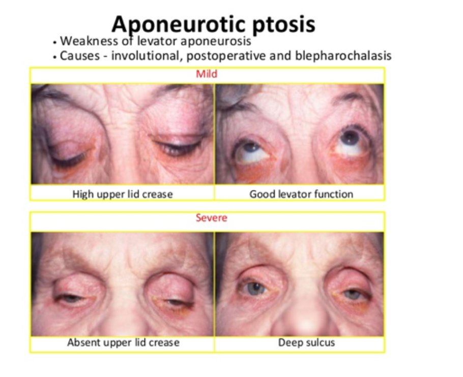 Carrick Institute (@thecarrickinst) on Twitter photo #eye <a href="/drfrcarrick/">Ted Carrick</a> Prof Carrick discusses Aponeurotic Ptosis - most common type of acquired ptosis- levator aponeurosis dehisced or disinserted from the tarsus #eyemovements #carricktrained #eye <a href="/drfrcarrick/">Ted Carrick</a> Prof Carrick discusses Aponeurotic Ptosis - most common type of acquired ptosis- levator aponeurosis dehisced or disinserted from the tarsus #eyemovements #carricktrained