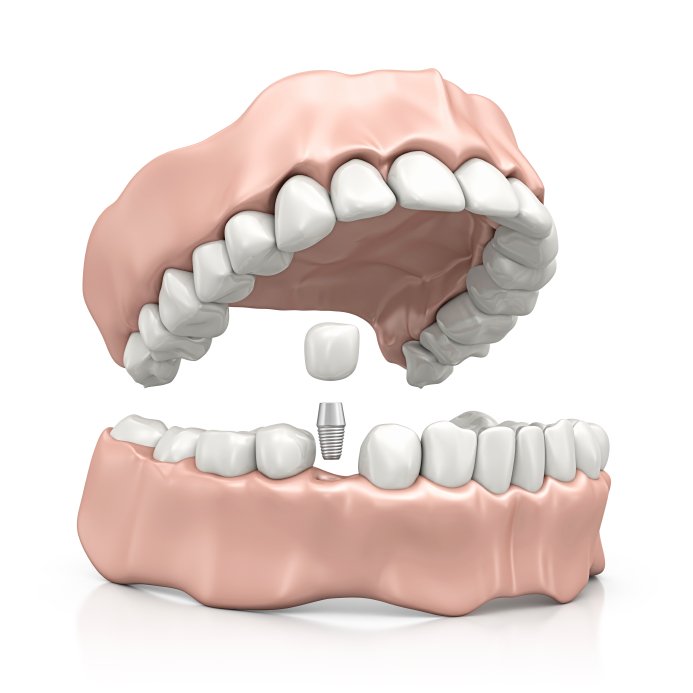 PerioNews's tweet image. A dental implant is often a small titanium post and abutment holding a replacement tooth. ow.ly/wwvv30ge3kh