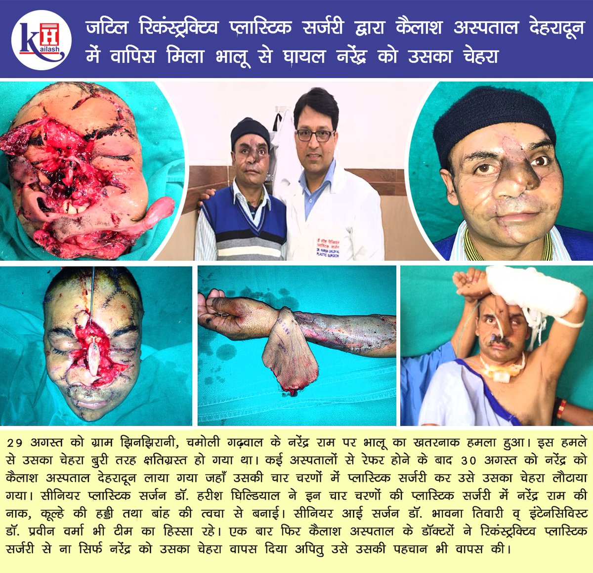 KailashHealth's tweet photo. #ReconstructivePlasticSurgery #RareSurgery #KailashHospitalDehradun #Emergency
जटिल रिकंस्ट्रक्टिव प्लास्टिक सर्जरी द्वारा कैलाश अस्पताल देहरादून में वापिस मिला भालू से घायल नरेंद्र को उसका चेहरा
आगे पढ़े: https://t.co/knYYLqNIzj https://t.co/X4yAFf2bVP
