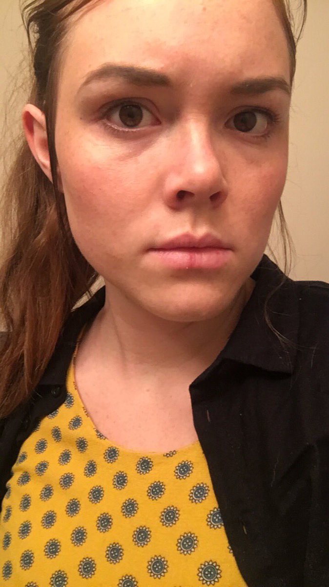 izzybergquist's tweet image. My split lip makes me look cool like I got in a fight but jokes on me it’s actually just winter wounding me with arctic air.