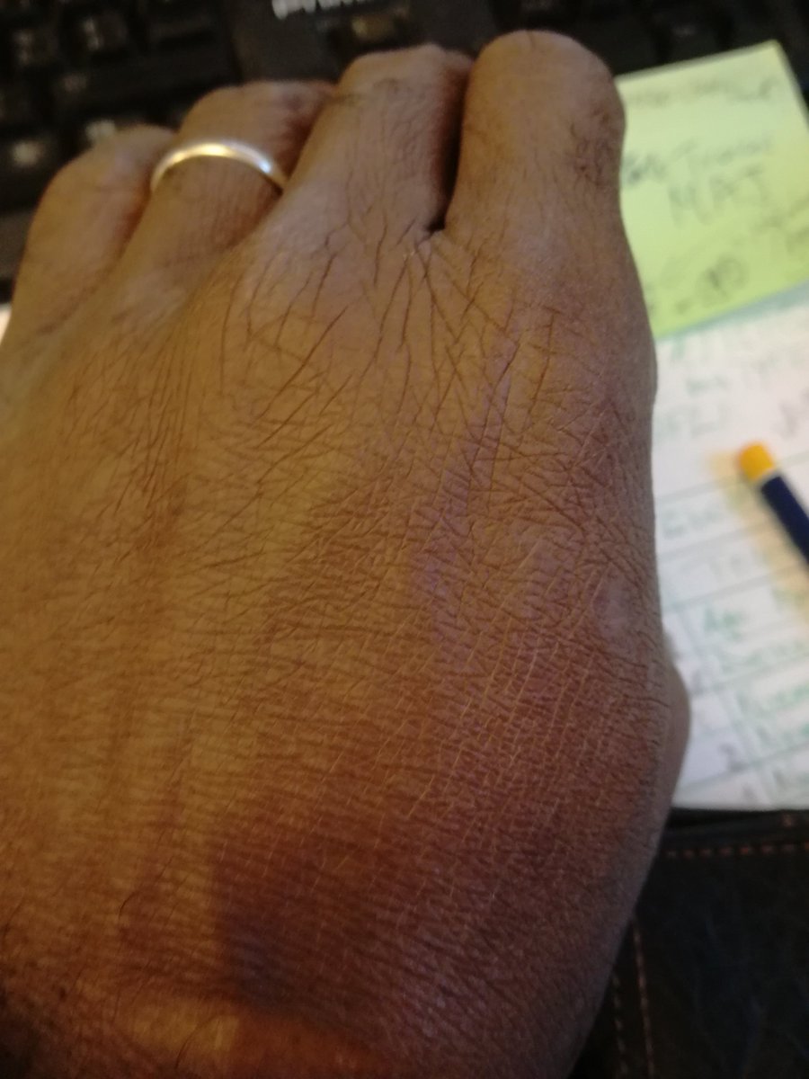 QuamPortoRico's tweet photo. They left light till very late (or very early) but I think (maybe I'm wrong) this is a part  of the psyghologic games they play to cover the crimes they are comitting. Here are some pictures of my hands during the Burning Attacks. https://t.co/IhoEFGAiJz