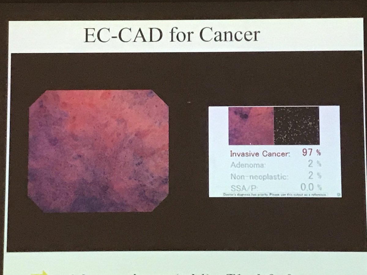 cparisinos's tweet photo. Prof. Kudo lecture; simple to use endocytoscopy + artificial intelligence software #endobrain is easy, accurate, real-time, > halves unnecessary surgery; end of fibrosis causing biopsies? #KingsLive2017 https://t.co/2SJuxpO0RX