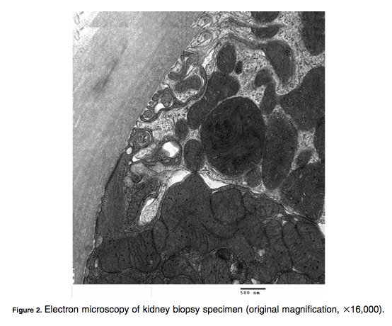 AJKDonline's tweet photo. FREE #Quiz What is the differential diagnosis for #AKI in patient with HIV infection treated with combination antiretroviral therapy? What does the kidney biopsy demonstrate? https://t.co/eJHF9J6Jre #AKI https://t.co/Qxr4tw2bmS