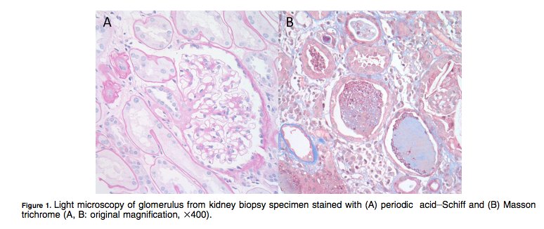 AJKDonline's tweet photo. FREE #Quiz What is the differential diagnosis for #AKI in patient with HIV infection treated with combination antiretroviral therapy? What does the kidney biopsy demonstrate? https://t.co/eJHF9J6Jre #AKI https://t.co/Qxr4tw2bmS