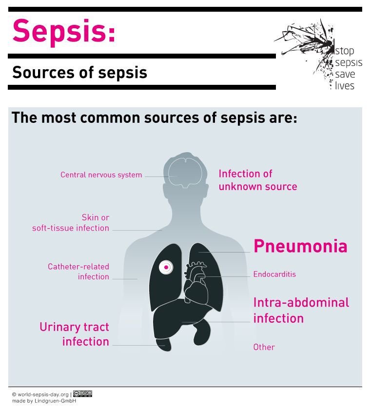 Pneumonia And Sepsis Pneumonia 2020