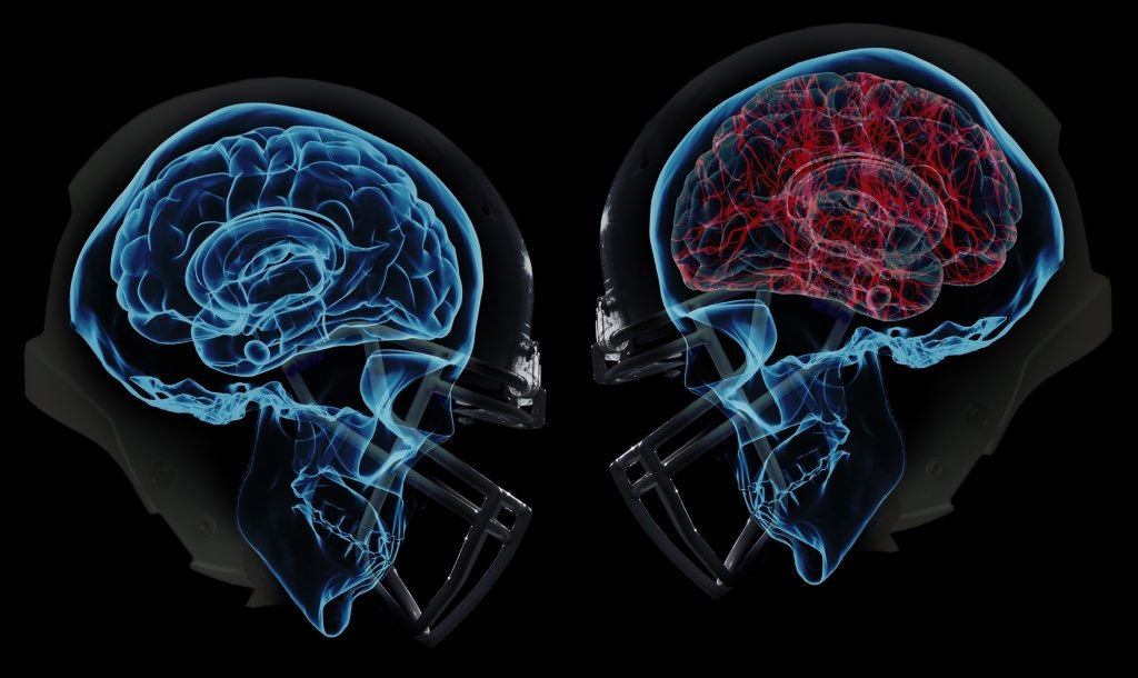 #Concussions are on the rise, but so are prevention and diagnosis technologies, especially for #football players. READ: 2 New Concussion Innovations on the Field #ImpactInnovations
impactinnovations.weebly.com