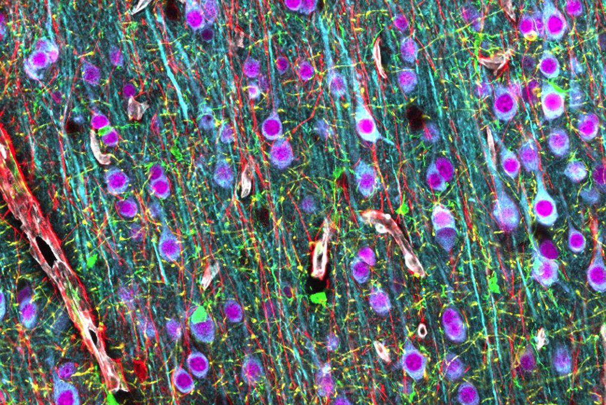 SinaiBrain's tweet photo. Presentation 205.09 / D20 - @Merina_V is presenting “Cellular & synaptic pathology in intractable #epilepsy: Observations from surgically resected #seizure foci”. STOP BY and learn more! #HofLab @icahnmountsinai #SfN17 https://t.co/xeiM0JaJb0 https://t.co/4XU6zUxIiY