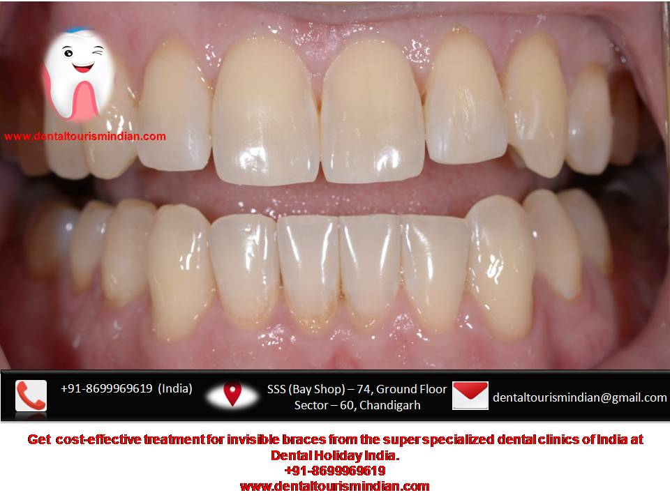 india_dental's tweet photo. #invisalignorthodontist #invisalign #invisaligncost #invisalignbraces #invisiblebraces
+91-8699969619
https://t.co/Dzq7ZIyhTB https://t.co/PjW9rF8ytY