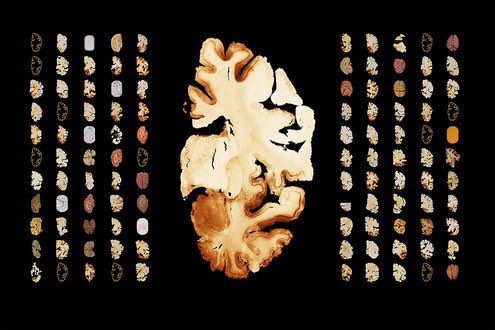 DocBlock_neuro's tweet photo. Iverson et al. highlight the need to separate #CTE neuropath from its clinical features. https://t.co/qbkdQWZl7x https://t.co/w7CmO7MJYG