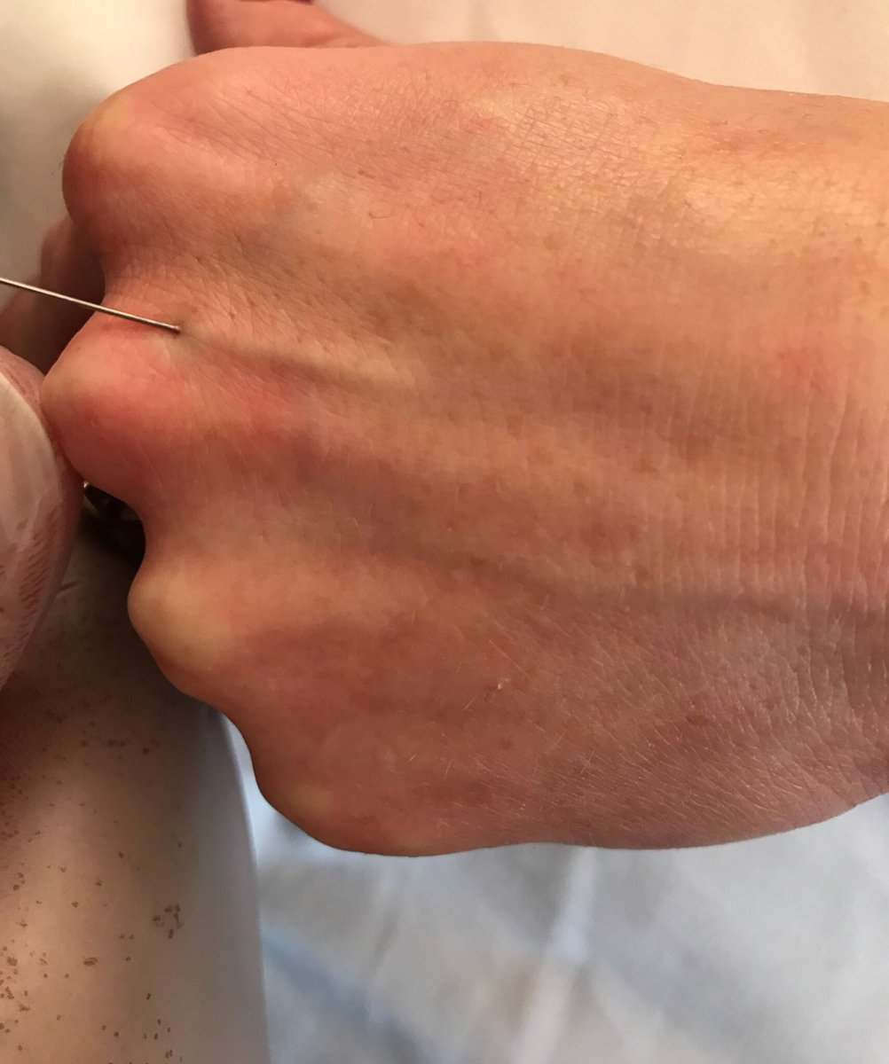 DrTijionEsho's tweet photo. Hand rejuvenation using @ha_dermauk @profhilo_uk with cannula technique #handlift #handrejuvenation https://t.co/cSOOy1gh2q