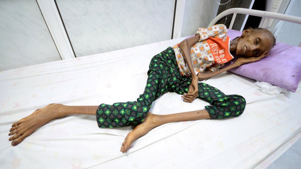 Guglielminetti's tweet photo. Le Yémen face à une famine massive. « Ce sera la plus grande famine que le monde ait connu depuis des décennies, avec des millions de victimes. » selon l’ONU. https://t.co/9Ochm2cDi4