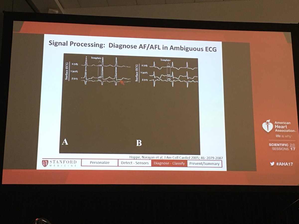 DebbeMcCall's tweet image. Signal processing In #afib and #aflutter  #aha17 @S_NarayanMD
