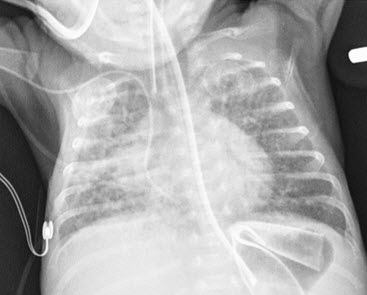 Online now:
Perforations by PICCs are rare!
Tip position may be modifiable risk factor!
ow.ly/CCRY30g3SrY
#PedsRad <a href="/socpedsir/">SPIR</a>