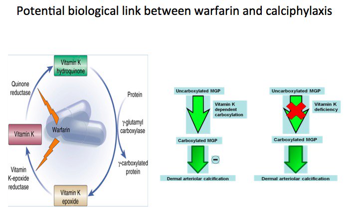 warfarin calciphylaxis