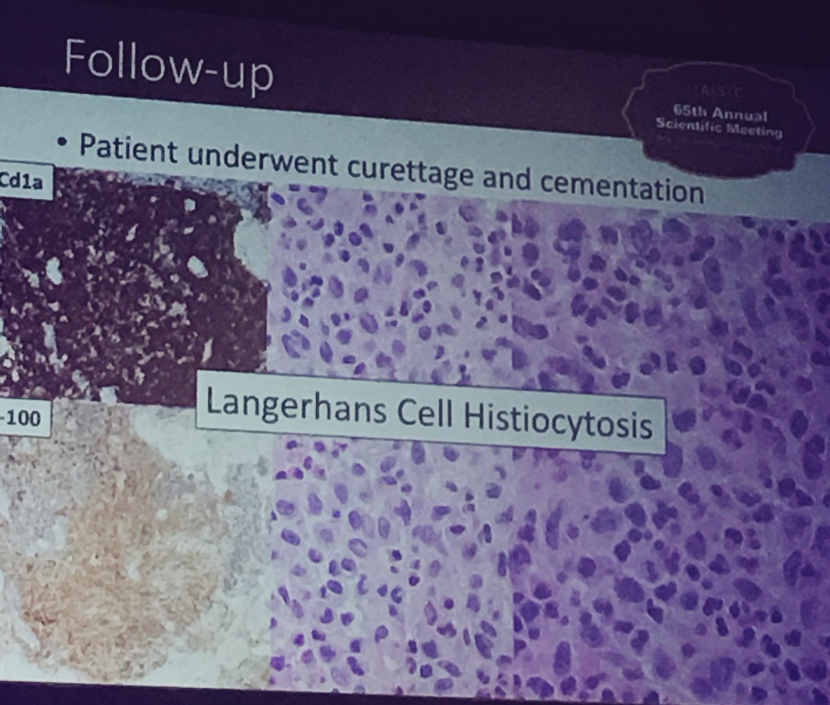 JL_Sauter's tweet photo. Dr Sara Monaco nailed case #8 of Diagnostic cytology seminar @cytopathology #ASCyto17 Diagnosis: LCH https://t.co/wVR0o4VuD8