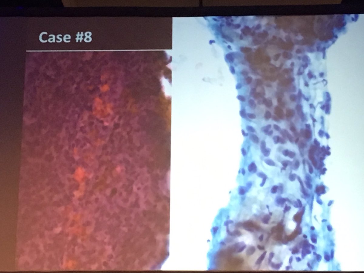 RoseannIWu's tweet photo. Case #8 54 yo M w/lytic lesion acromion = Langerhans cell histiocytosis
#ASCyto17 @cytopathology Great job Paul Staats, Jenna Benson, Michael Roh, Sara Monaco, Chris VandenBussche, Sean McNair!  @UMichPath @JHUPath @MayoClinicPath https://t.co/GbvHQ2JHyg