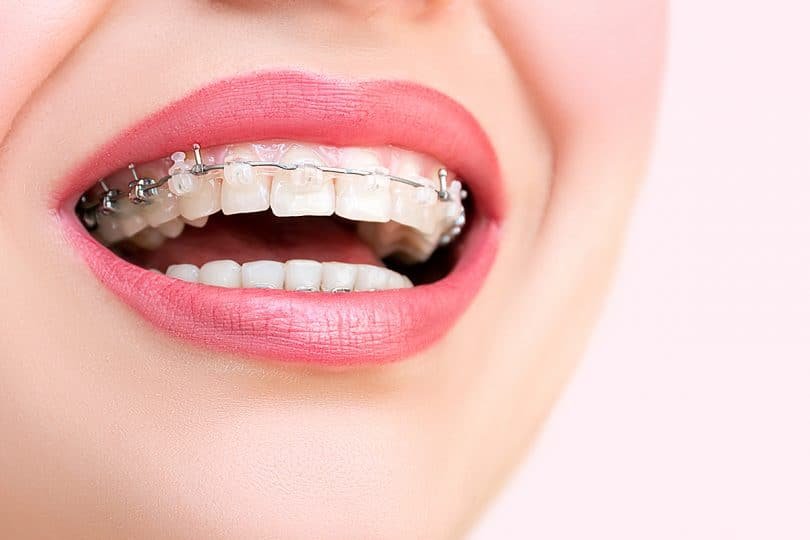 AgenceLJCom's tweet photo. [communiqué #presse] A l’occasion des #jo2017 rappel utile sur Les Français et l’ #orthodontie : 20 ans de progrès #santé @FFOrthodontie @BeryAlain https://t.co/uXqouoi9E6 https://t.co/bKzCRklaJl