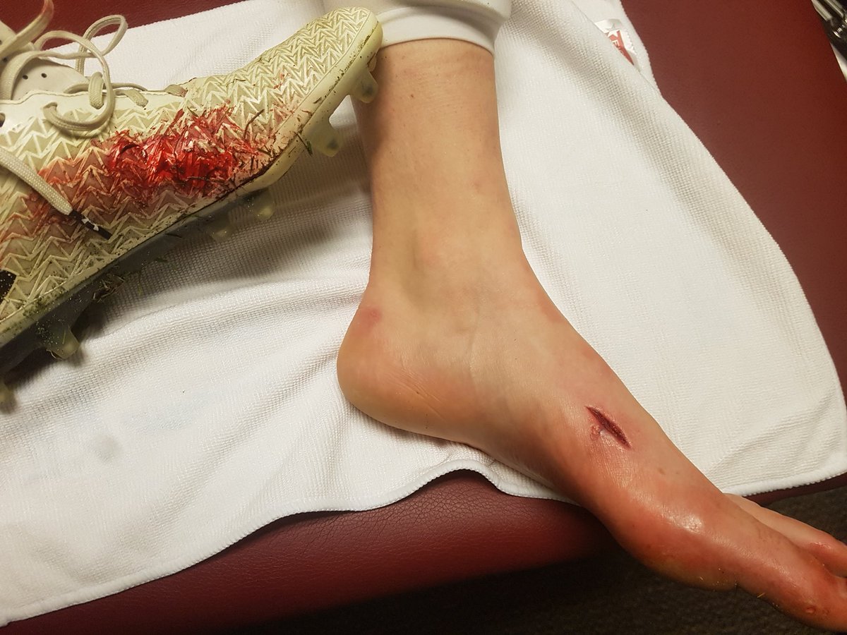 Well never thought another persons cleats could rip through my cleat, ankle brace and sock to give me stitches but hey learn something new everyday #rivarlygame 🇨🇦v🇺🇸@soccergirlprobs