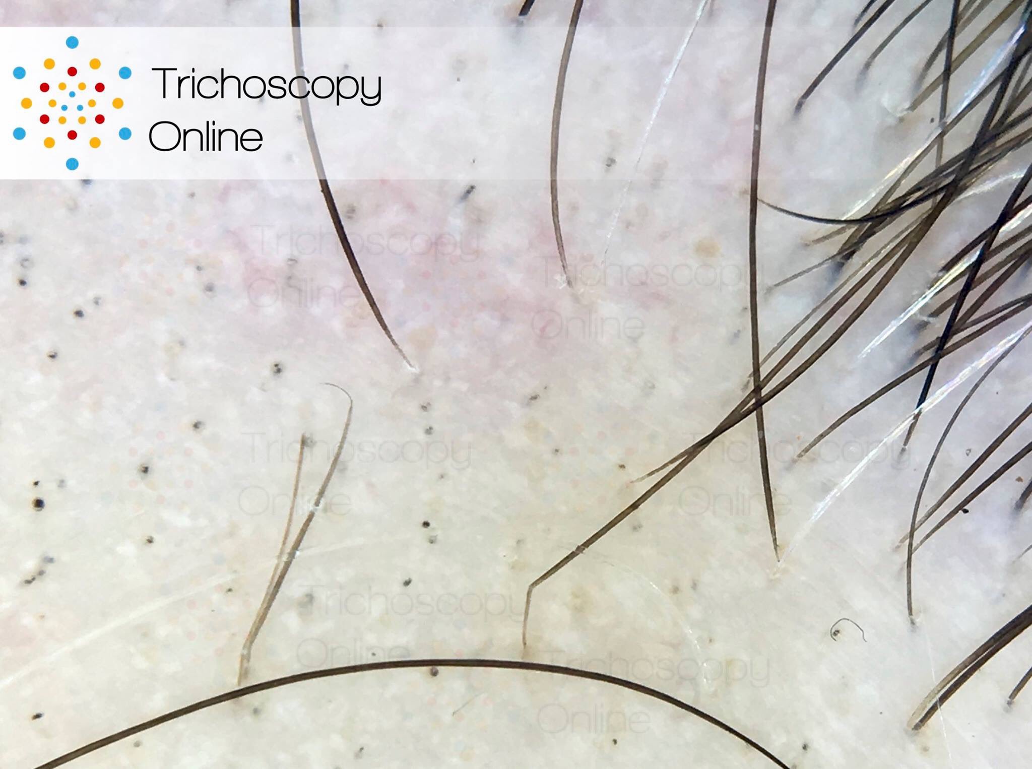 Trichoscopy Online on Twitter: 