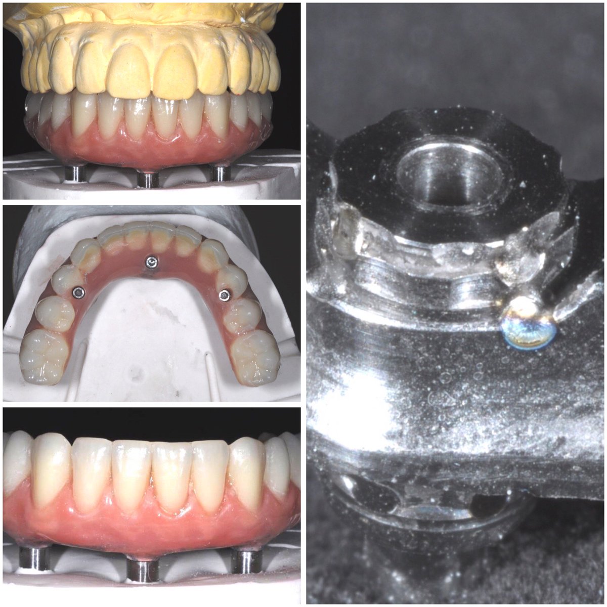 TBDentalLab's tweet photo. First completed Trefoil case in UK
#Trefoil #NobelBiocare #TrevorBrookerDentalLab #AndrewDawood #DawoodandTanner #EnigmalifeTeeth

Beautifully engineered, easy to laser weld to create passive fit. https://t.co/wQESR0uSxv