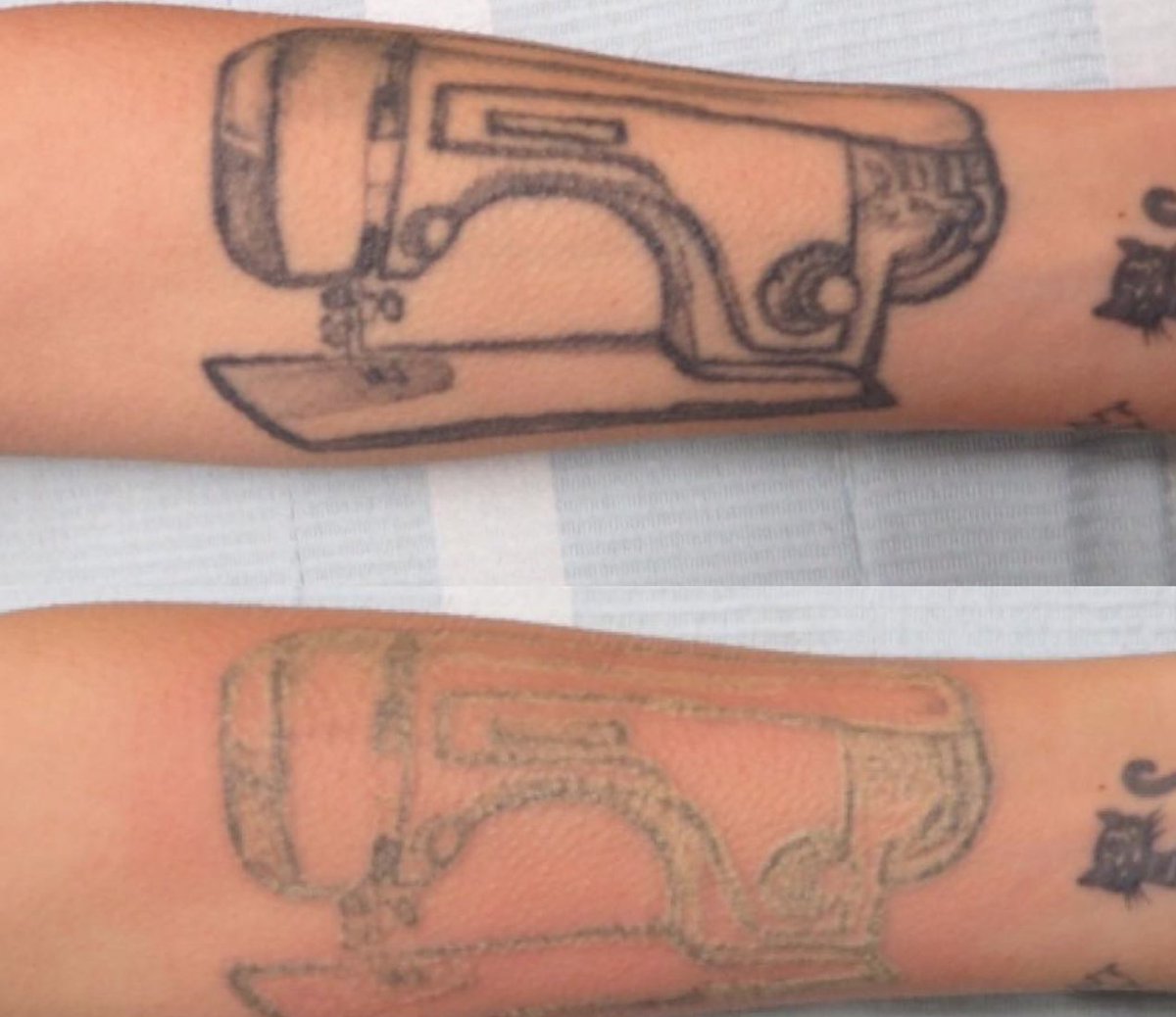 This bad boy will be gone in no time thanks to our state of the art <a href="/Picosure/">PicoSure</a> tattoo removal system.