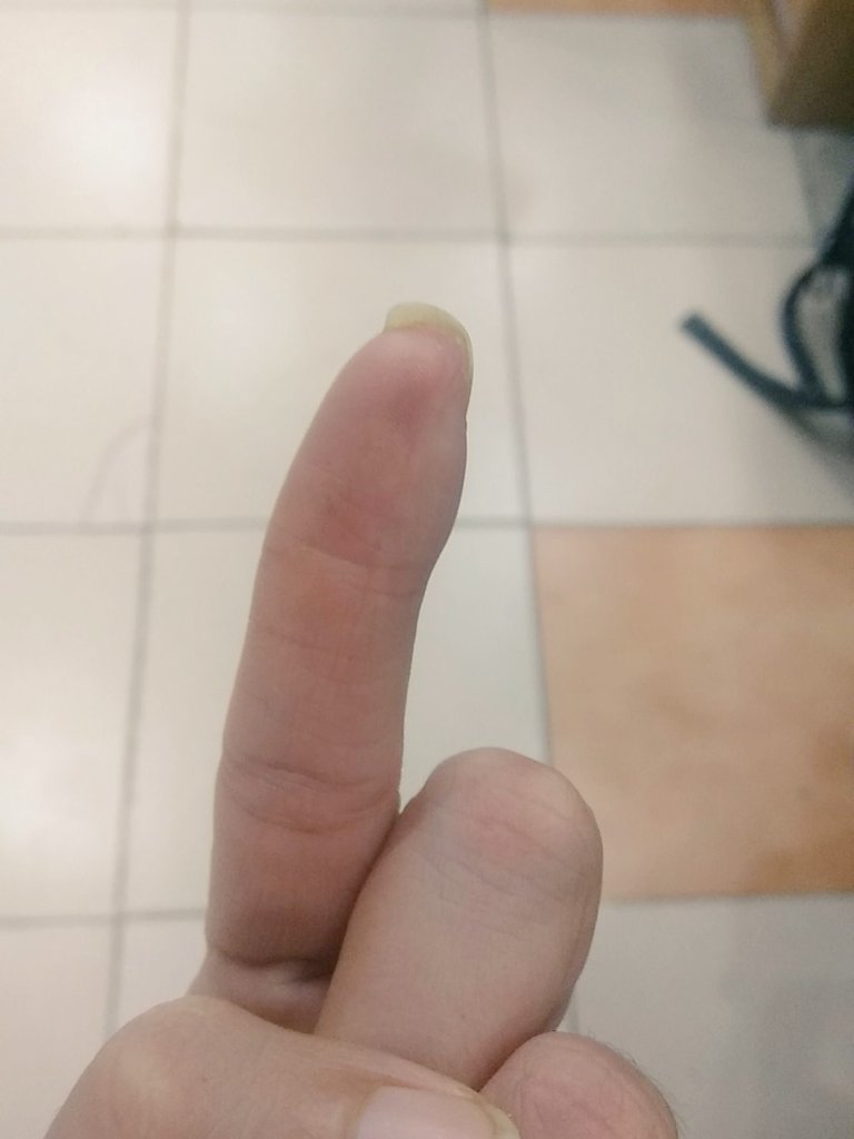 DilliBelle's tweet photo. @sidin I inserted my finger in the fan motor of my dad's scooter. It got sliced and to this day it's deformed. #rockstarchild https://t.co/aLiJO9dYSl
