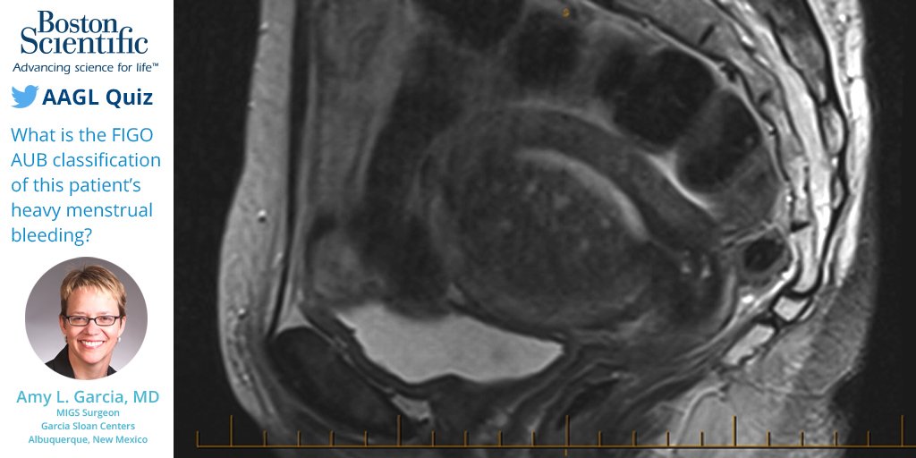AAGL's tweet photo. Retweet the @bsc_urology quiz question with your answer, and enter to win an Apple Watch from us. Winner announced tomorrow! #AAGL2017 https://t.co/WbvRgVDrQG