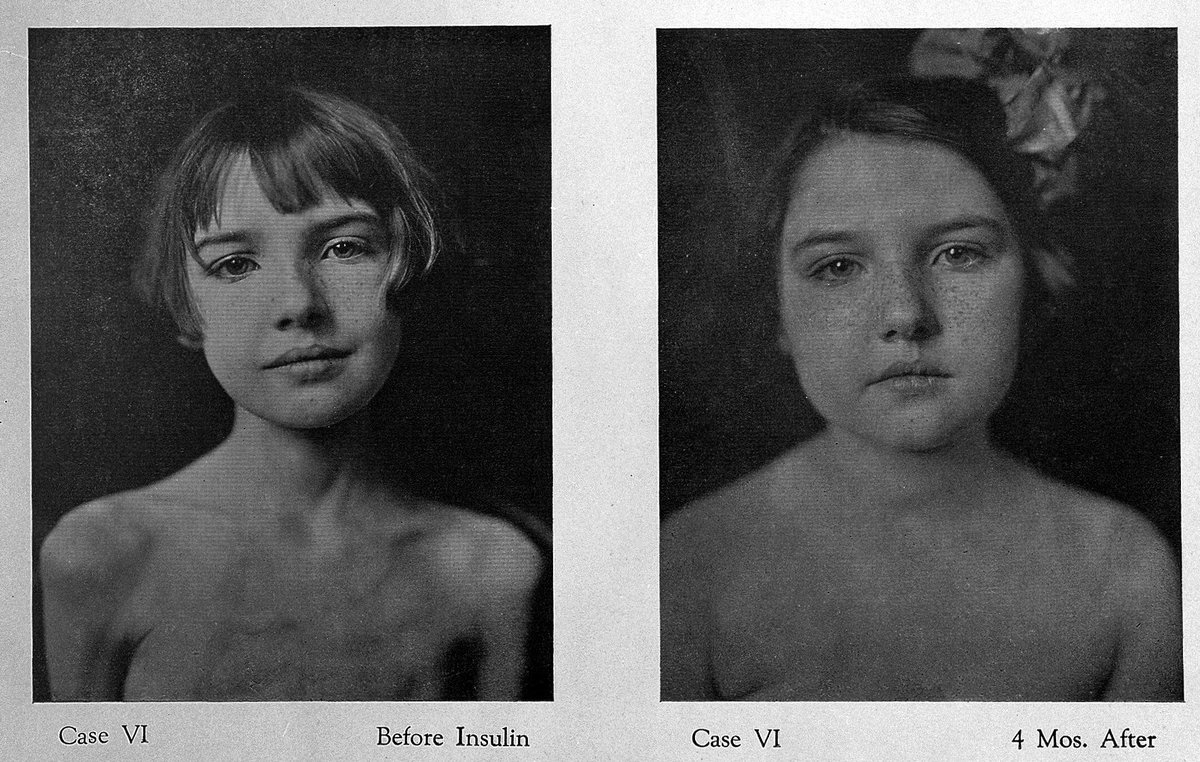 ExploreWellcome's tweet image. Before the use of insulin in 1922 diabetes was a deadly disease. The only hope those diagnosed with it had to prolong their life was, paradoxically, to be on a diet which took them to the very edge of starvation. #WorldDiabetesDay