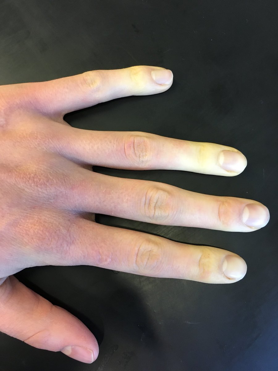 Trientist's tweet photo. #raynauds is sudden construction of blood vessels in hands/feet often in response to #cold. Reducing blood flow to exposed/cold digits maintains core body temp.#medfacts #wintercommute #morningscience https://t.co/o2HKoFFXQU
