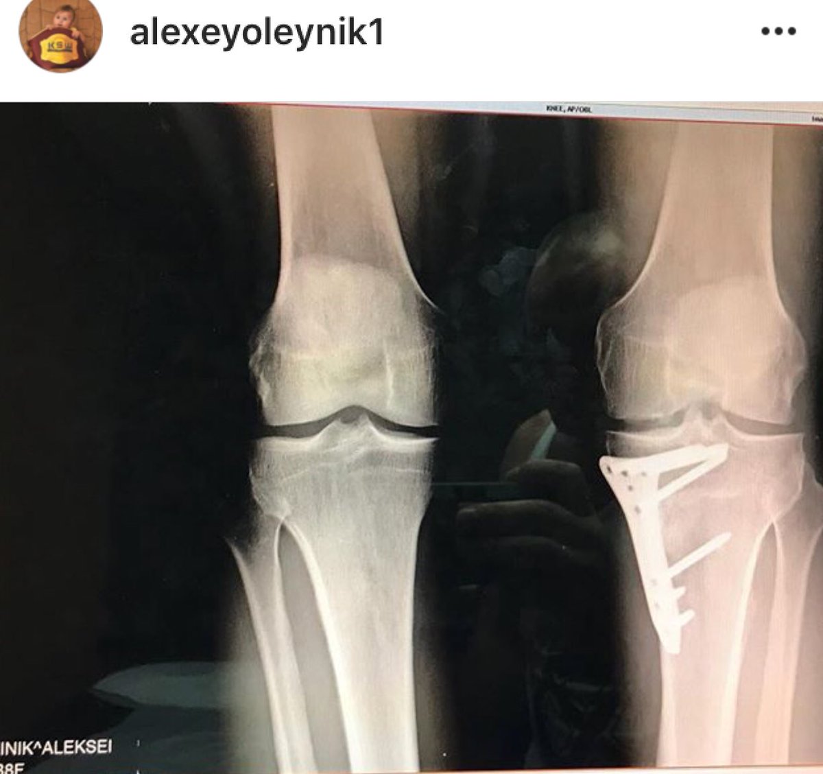 BraveIgor's tweet photo. @oleynikufc has screw on his leg and fight with it 3 last years. He can’t make shots by this leg, can’t run. But he is real man! 💪🏻 https://t.co/tsHS4dgqXJ
