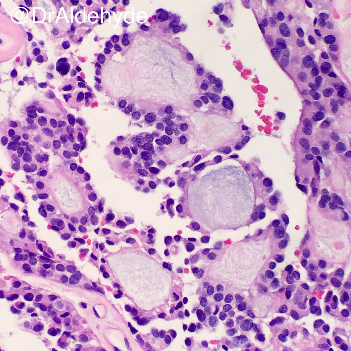 DrAldehyde's tweet photo. Myxopapillary ependymoma = filum terminale = cauda equina 🐴🔬#NeuroPath #Pathology #HHPath @HHPathology @BeRaad87 @SueEPig @SiddiqueA_MD @cruzjorgef @okhanMD @MishiePishi @EaswarMd @Safina8552 @BerkaLurk @therealbsym @MyPwang https://t.co/1FZZrXwktQ