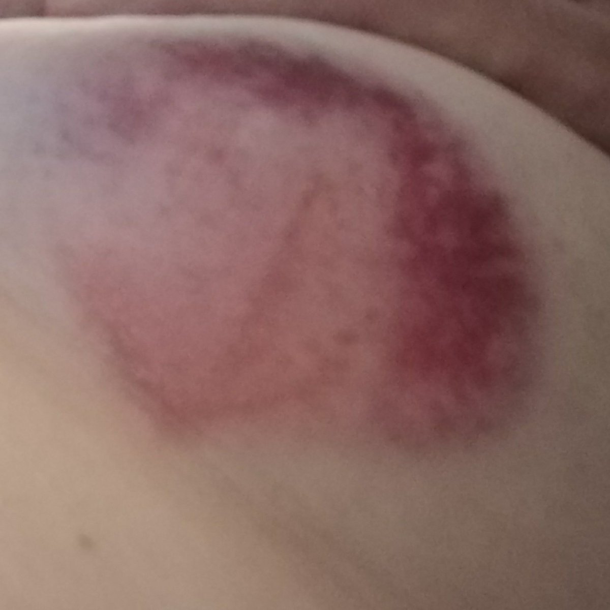 NikkiRunsUK's tweet photo. Had a fall yesterday and this is the damage 😭😭 so sore. #hurt #bruise #felldownstairs https://t.co/Ntv2HY1vQv