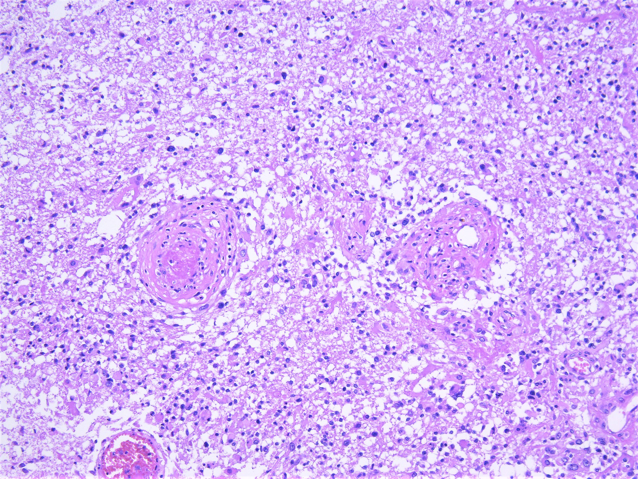 Pathology WalkerAuto Tweet Bot on Twitter "Glioblastoma, IDHwild