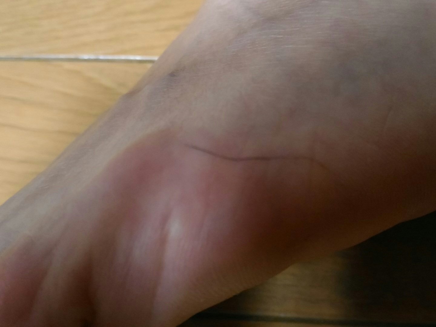 田代沙織 質問 7日前 母の足裏の皮膚に 黒い糸くず状のものが入り込んでいて 今日はそれが足の甲側に移動していました 皮膚の中に入り込んでいるのですが これは何でしょうか Gt Lt 明日にでも皮膚科を受診させ様と思うのですが ちょっと心配