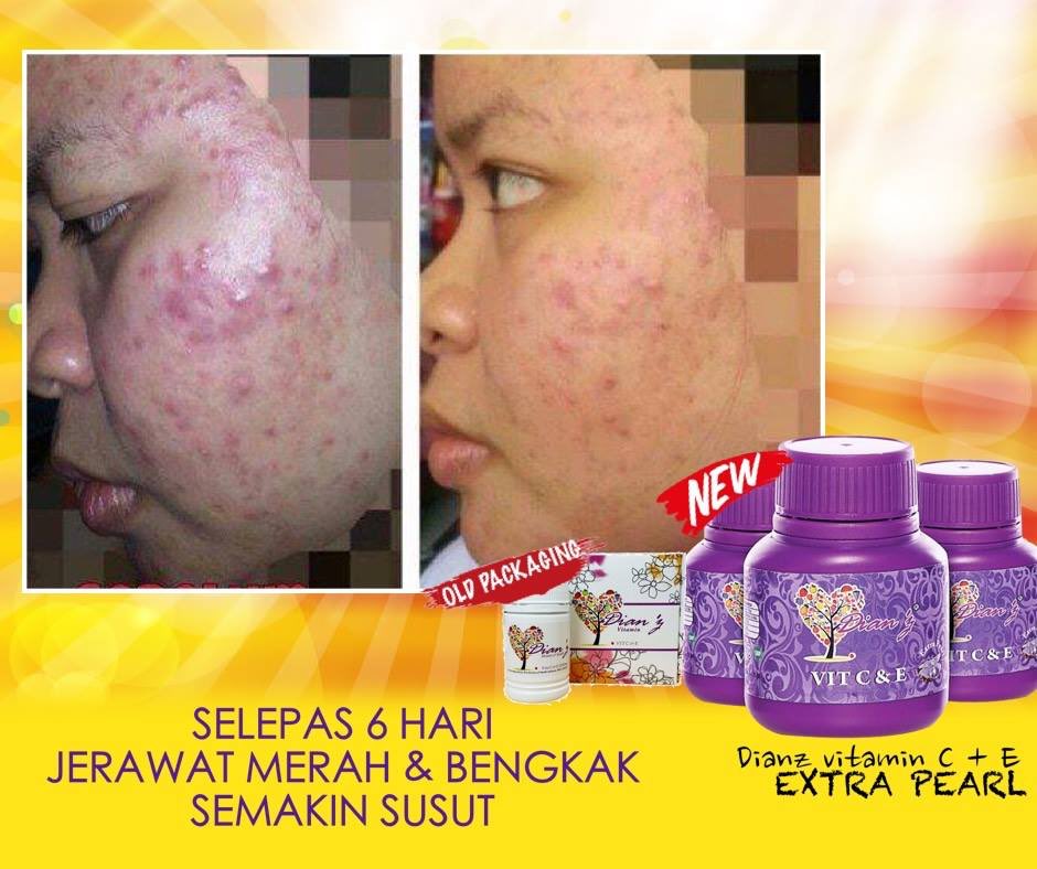 dianz_vit's tweet photo. ramai yang setia dgn dianz vit bukan sebab nak kulit cerah semata. tapi ia sesuai untuk segala jenis masalah kulit, jerawat, jeragat, ekzema &amp; parut.
📲 : https://t.co/xusRK0rN0N https://t.co/cvoc0oweoI