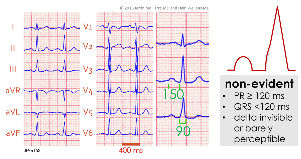 ECGcorner's tweet photo. non-evident #ventricular #preexcitation
https://t.co/ZPWxYYHWtr
#electrocardiography #ECGlovers #FOAMed #ECG https://t.co/7KXm6YB2Zb