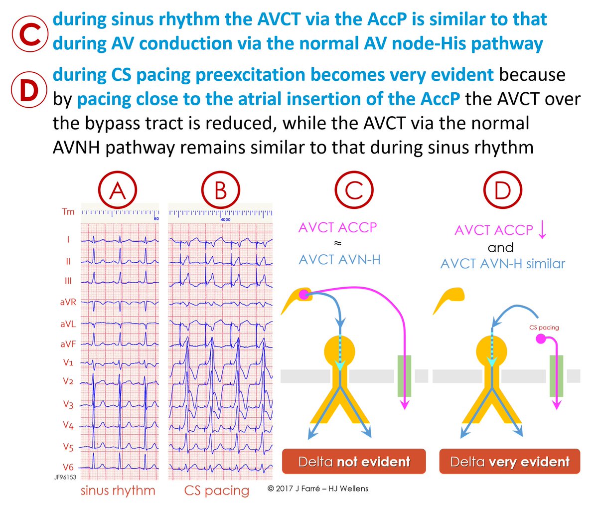 ECGcorner's tweet photo. non-evident #ventricular #preexcitation (sinus rhythm/CS pacing) 1/2
https://t.co/ZPWxYYHWtr
#electrocardiography #ECGlovers #FOAMed #ECG https://t.co/BPP35KacYC