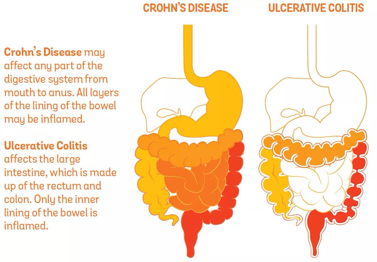 CrohnsColitisUK's tweet photo. What's the difference between #Crohns Disease and Ulcerative #Colitis? 

Read our Understanding #IBD booklet for more info: https://t.co/9ueFHp0X1Q https://t.co/0wsVLUfMAk