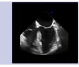 learnECMOteam (@learnecmoteam) on Twitter photo Talk by <a href="/GomorraDoc/">Sean Scott</a> on mechanical compressions for #ECMO CPR.
Reduce risk of malposition with neck strap. Check position visually & on TOE each cycle Talk by <a href="/GomorraDoc/">Sean Scott</a> on mechanical compressions for #ECMO CPR.
Reduce risk of malposition with neck strap. Check position visually & on TOE each cycle