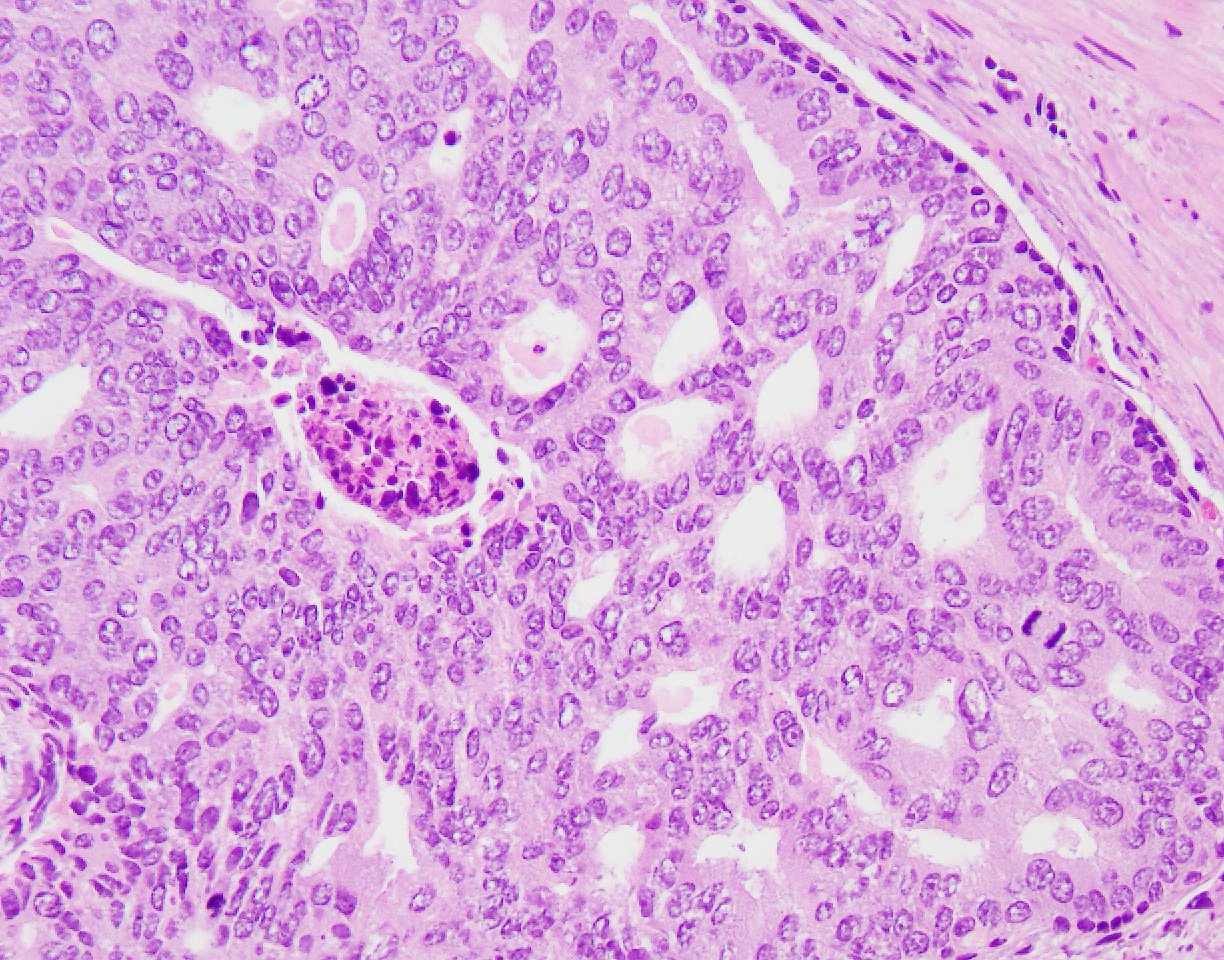 Samson W. Fine, MD on Twitter: "Intraductal carcinoma of the prostate