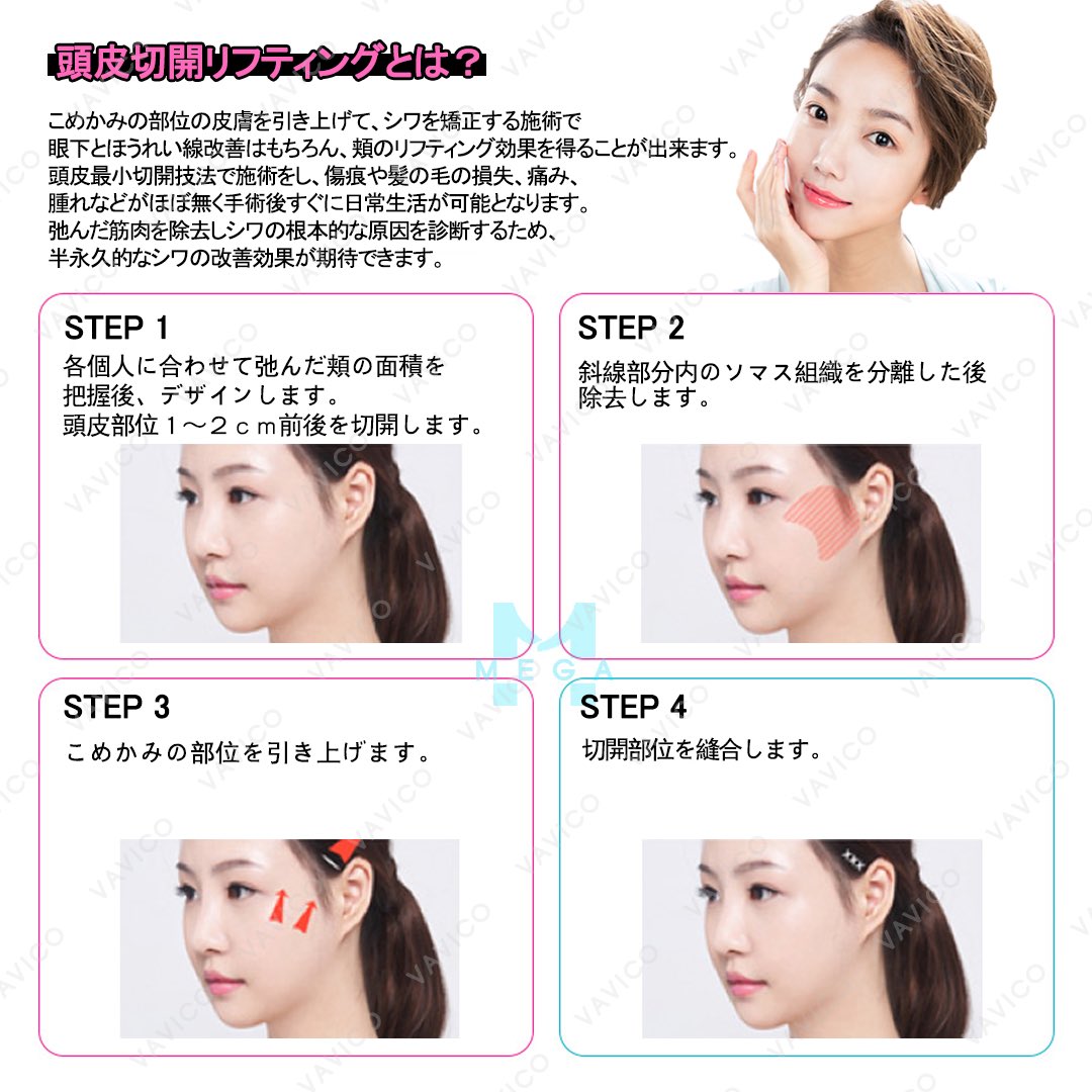 vavicojapan's tweet photo. リフトアップして若さをゲッド👸🏻💖
#韓国 #美容 #整形 #バビコ #vavico #通訳 #サポート #メガ整形外科 #vライン #おでこ #リフティング #しわ #改善 #若返り #可愛くなりたい https://t.co/826x0Wc5FR