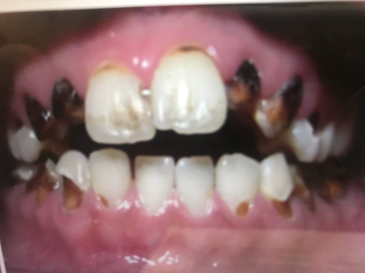 johnnywalker04's tweet image. DYK: “meth mouth” come from methamphetamines acting on the alpha-adrenergic receptors, it shuts off salivary flow. This deprives the mouth of salvia’s buffering ability to counteract acidity. #BadStuff #DontDoDrugs