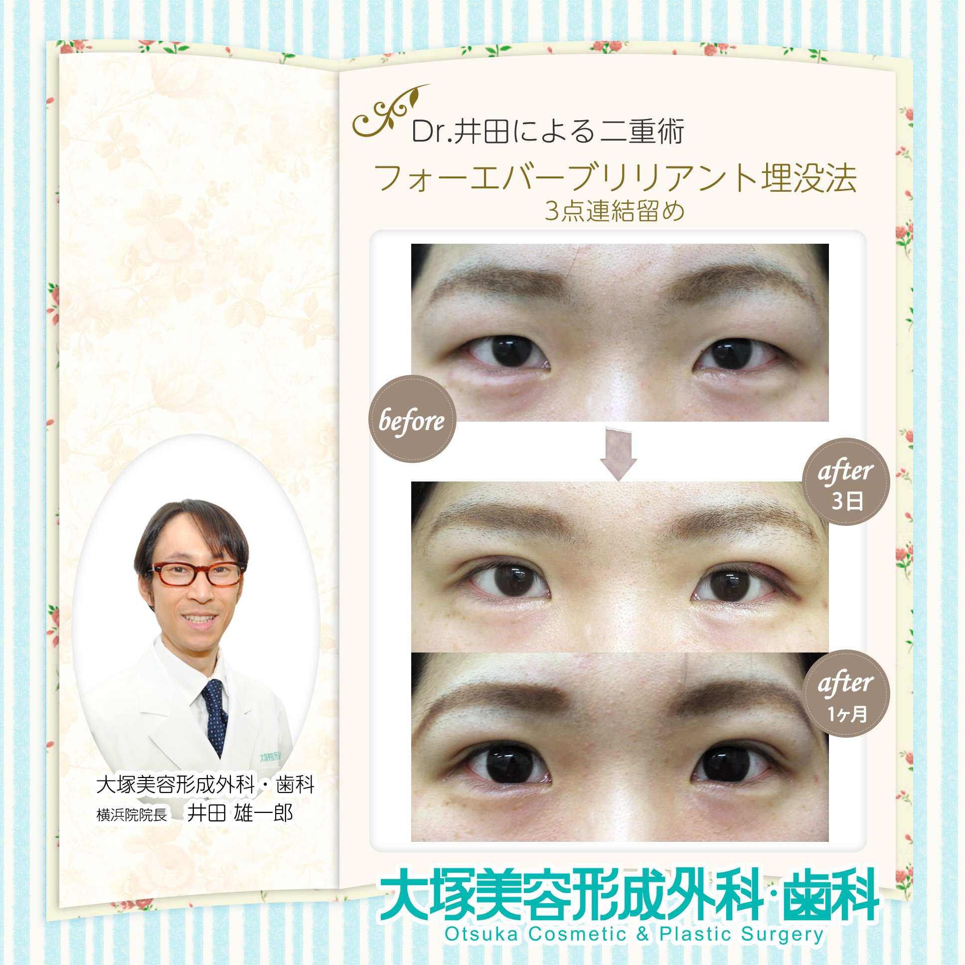 大塚美容形成外科 歯科 公式 Twitterissa 横浜院院長 井田先生の最新ブログより アイテープでは思うように二重を作ることができなかった患者様の術後経過のご紹介 新しいお目元はいかがでしょうか 大塚美容形成 外科 二重