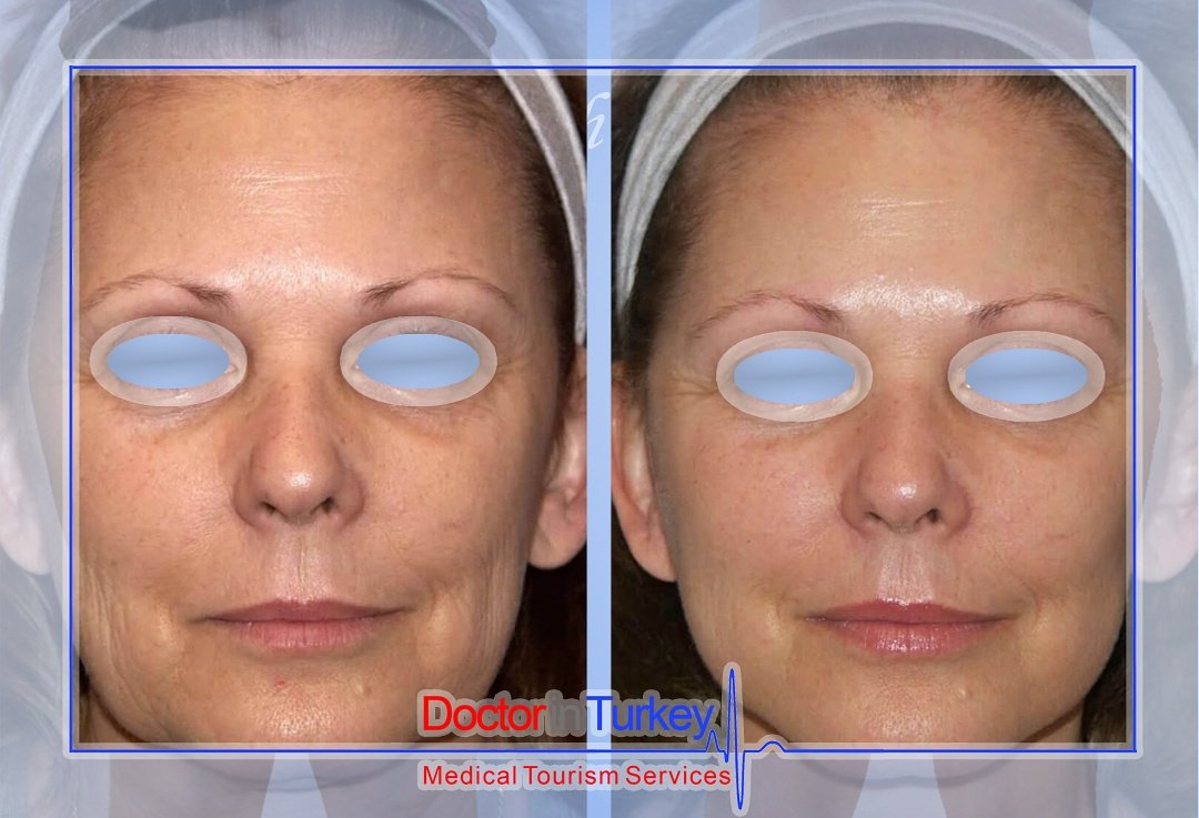 medigance's tweet photo. Botox Operations, Dermal Fillers, Face Lifting and all others ! 💃💃

Depending on your needs, we offer you the best location and surgeon ! 🏁🏁

For your quotes, you can write emails to info@doctorinturkey.com 

Or fill our forms in https://t.co/TkF3C4KRFd https://t.co/5oUAtepDUV