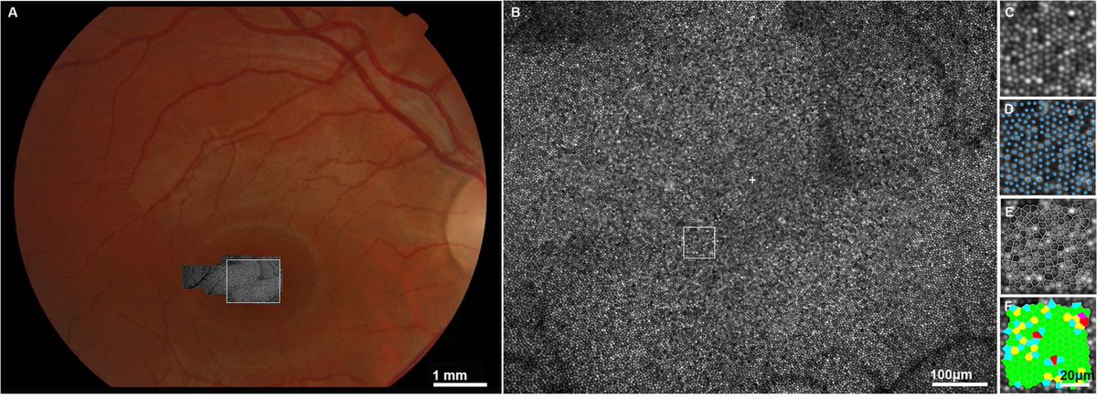 UCL_Retina's tweet photo. Adaptive optics imaging of inherited retinal diseases.  @BJOphthalmology 

https://t.co/SKTPvOcXo7

#AO #AdaptiveOptics #OCT #Stargardt #achromatopsia #RPGR https://t.co/pazBzbxpbT