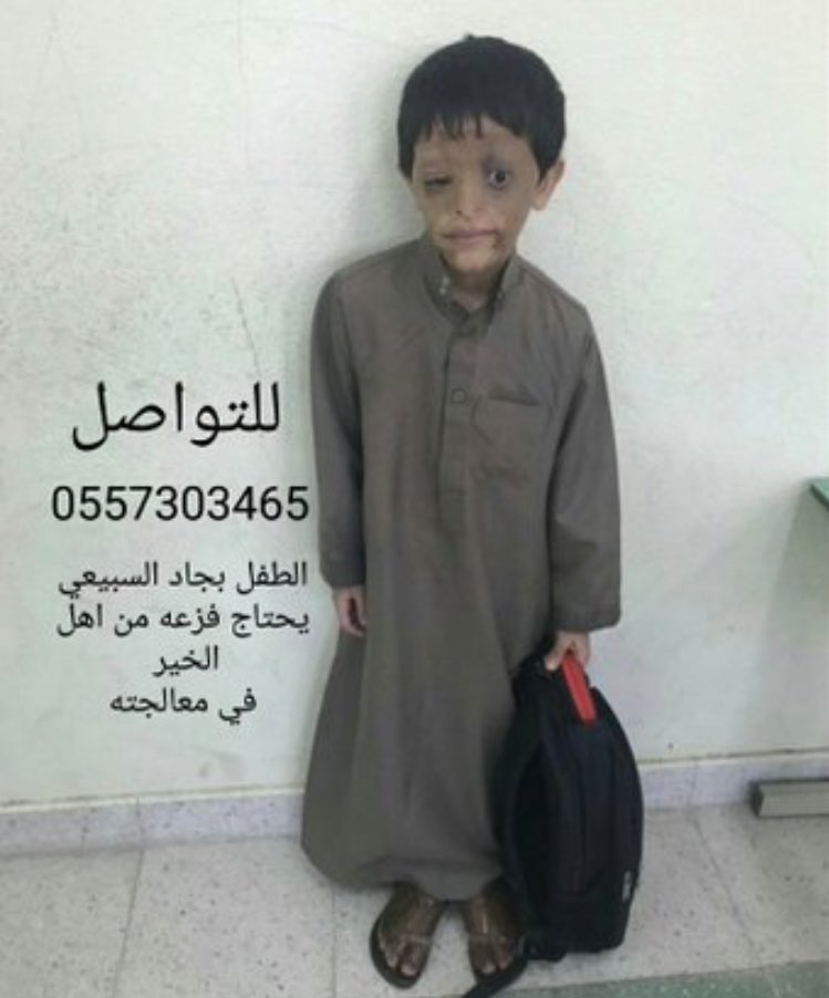 اللهم اشفى كل نفس ذاقت طعم الألم ،، 
اللهم اشفى مرضانا ومرضى المسلمين 
اللهم اذهب البأس أشفى انت الشافى لا شفاء الا شفائك

ساكون معكم الساعه ٧ باذن الله في رفع التاق 
نتمنى المشاركه وجزاكم الله خير👌🏻

 #انقذوا_الطفل_بجاد