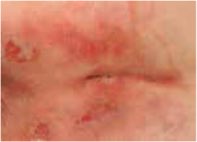 NELFT's tweet photo. These photos can be hard to look at but it’s important to learn what to look for. The early signs of skin damage can be subtle.  Ask for help if you’re worried about your skin #stopthepressure https://t.co/56hXC9dBUB