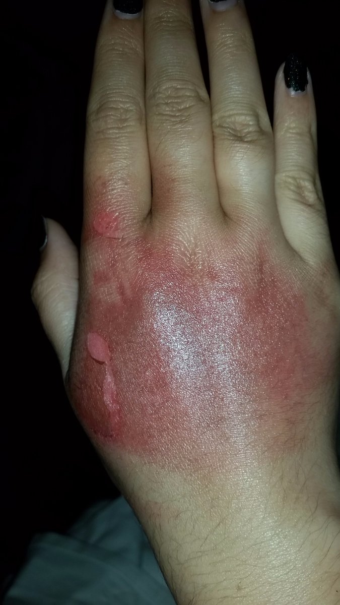 tablenine's tweet photo. Day 1, Day 6, Day 11 and Day 19. The human body is miraculous. Also bless @jellybean1217 for advising me to get Cocoa butter and bless @palmersworks cuz WOW. #NotAnAdJustTheTruth https://t.co/lFDIdOGtGS