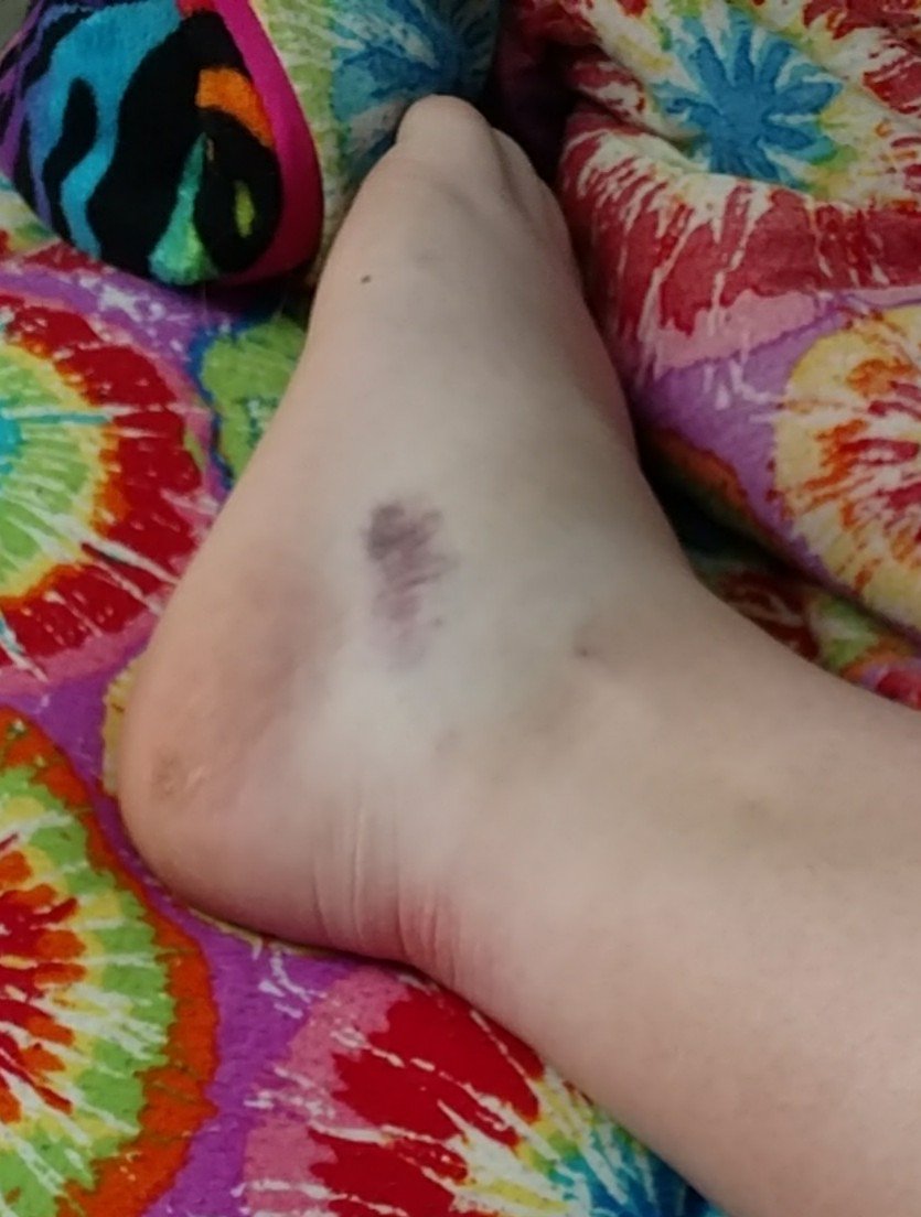 hewins11's tweet photo. Only I would!!!  #AccidentProne 
#NeedABubble https://t.co/bNAa1TMI3g