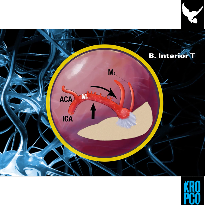 kropco's tweet photo. Realizamos animaciones 2D para explicar distintos tipos de aneurismas y su intervención. #Kropco #Diseño #Ilustración #Animación #Neurocirugía https://t.co/7ZfzsPbxrC